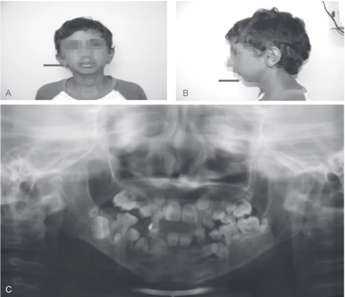 Figura 2. Fotografias de frente e perfil e radiografia panorâmica. A. Fotografia frontal do paciente, mostrando assimetria facial provocada  pelo defeito na região parotídea do lado direito aos 10 anos de idade (seta); B