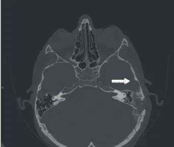 Figura 3. Tomografia computadorizada. Corte axial mostra  envolvimento da região mastóidea do lado esquerdo pelo  osteossarcoma (seta)