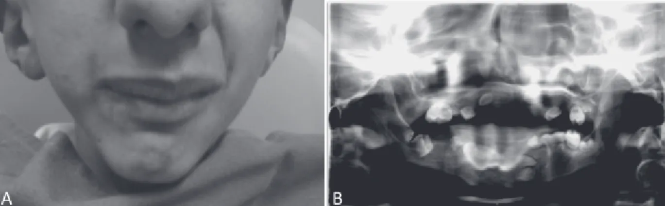 Figura 4. Fotografia e radiografia panorâmica. A. Fotografia frontal em maio de 2012, aos 18 anos; B