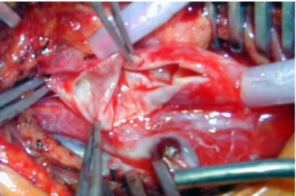 Figura 1. Endarteriectomia da artéria carótida.  