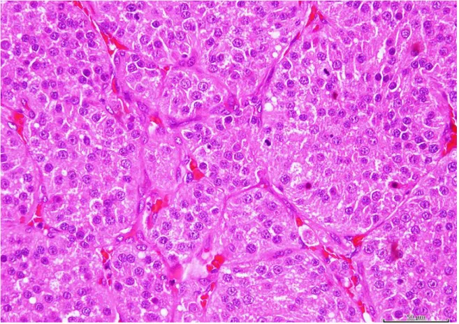 Figura 3. Imagem de corte histológico de testículo com tumor das células de Leydig. Hematoxilina  e Eosina (H&amp;E)