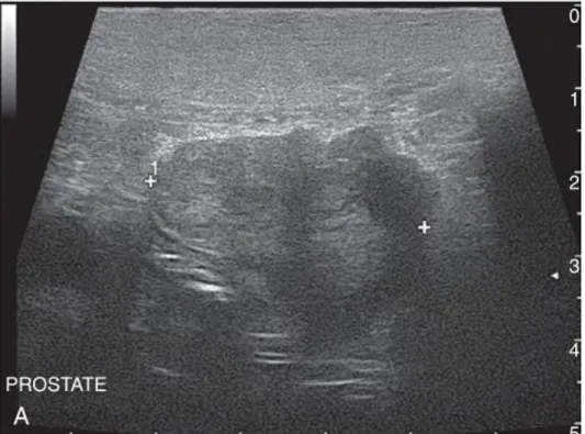 Figura  6.  Imagem  ecográfica  de  próstata  neoplásica  de  cão  em  varrimento  transversal mostrando assimetria entre lóbulos e um parênquima heterogéneo