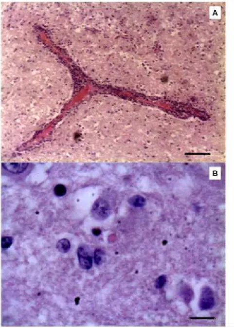 Figure  1  -  A)  Endothelial  reactivity  with  nuclear  swelling  and  mild  perivascular  cuffing  of  mononuclear cells (HE, Obj 40x)