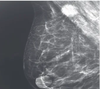 Figura 1. Nódulo no quadrante superomedial da mama direita de  limites mal definidos e espiculado sem microcalcificações