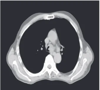 Figura 2. Distribuição de dose do planejamento de radioterapia Figura 1. Tomografia de tórax mostrando tumor localmente avançado no terço distal da traqueia