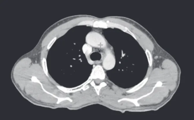 Figura 3. Tomografia de tórax realizada 2 anos e 10 meses após  término do tratamento evidenciando resposta completa à terapêutica