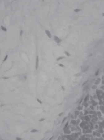 Figura 3. Células estromais apresentam-se fusiformes ou estreladas  entre fibras colágenas delgadas e abundante material mixoide (400x)