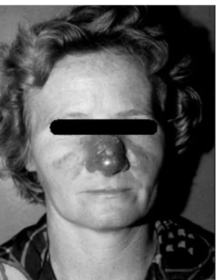 Figure 1 - Extensive nasal lesion in patient included in the present study 