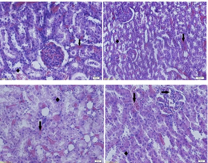 Figure 10 - Kidney sections of Diabetic furan+lycopene rats X200, H&amp;E. hemorrhage (↓), Tubular degeneration  (♦), glomerular lobulation (→)