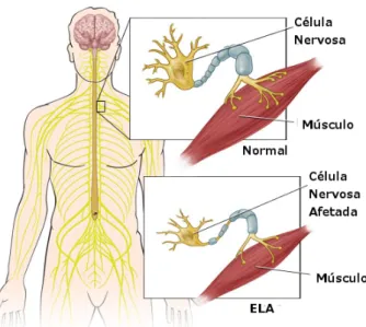 Figura 1.1: Células do nervo muscular: normal e ELA