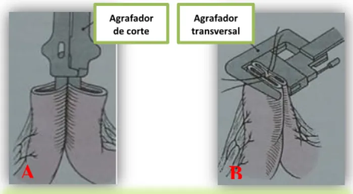 Figura  19.  Ilustração  da  técnica  de  anastomose  lado-a- lado-a-lado (Adaptado de Hedlund, 2002) 