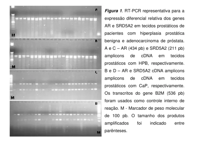 Figura 1. RT-PCR representativa para a  expressão  diferencial  relativa  dos  genes  AR e SRD5A2 em tecidos prostáticos de  pacientes  com  hiperplasia  prostática  benigna  e  adenocarcinoma  de  próstata