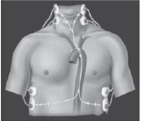 FIGURA 7  –  Posicionamento dos eletrodos na cardiografia por bioimpedância  torácica