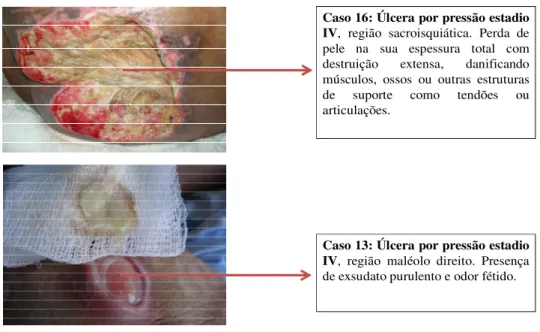 Figura 4: Fotos dos casos de úlceras por pressão estadio IV utilizadas no estudo para coleta de material clínico para avaliação da colonização/infecção por bacilos gram-negativos em pacientes de um hospital de nível terciário, no período de agosto de 2009 