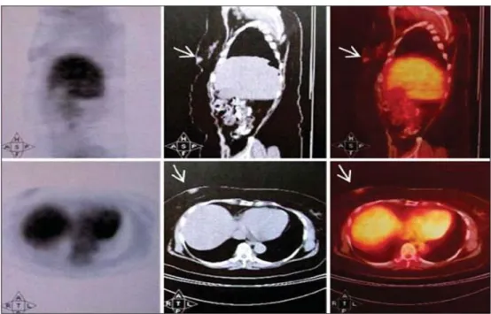 Figura 2: Tomografia por emissão de pósitrons acoplada a Tomografia computadorizada (FDG-PET/TC)  revelando aumento da captação de FDG na mama (setas)