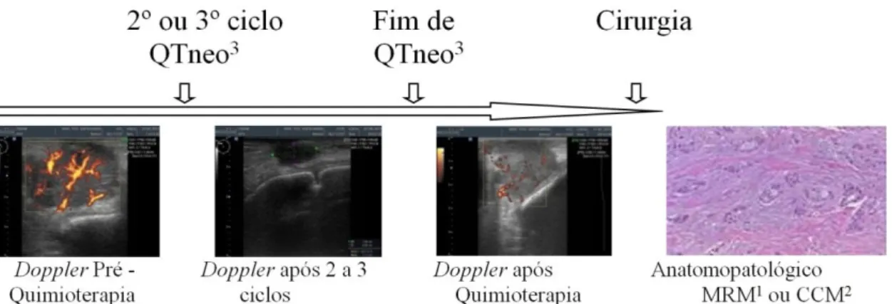 Figura  4:  Protocolo  de  avaliação  de  resposta.  1  MRM  =  Mastectomia  Radical  Modificada;  2  CCM  =  Cirurgia Conservadora da Mama; 3 QTneo = Quimioterapia neoadjuvante