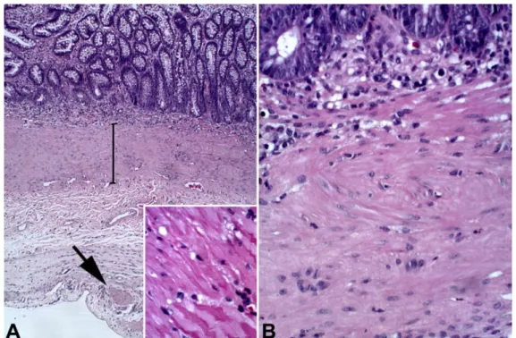 Figure  1.  Dog.  Small  intestine.  (A)  Extremely  thickened  muscularis  mucosae  (several  hundred  micrometers-thick) (bar) and complete loss of muscular layer in some segments (arrow)