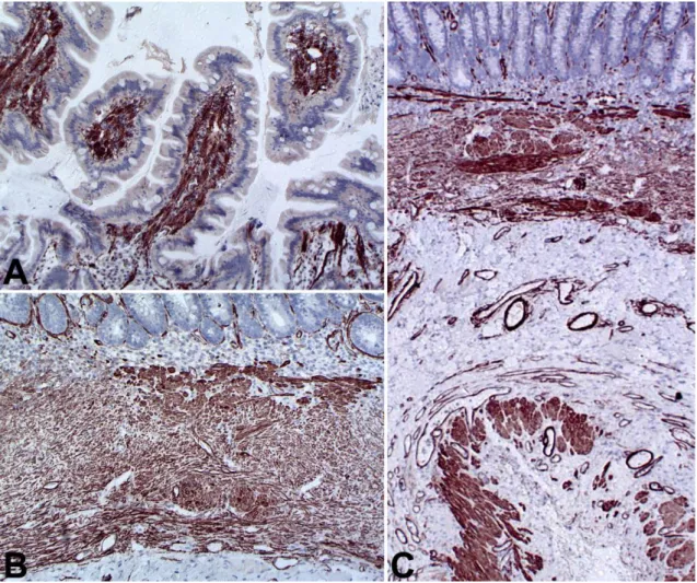 Figure 5. Dog. Small intestine. (A) Immunostaining of smooth muscle acting demonstrating an extensive  increase in the population of leiomyocytes in the lamina propria, IHC