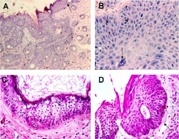 Figure 2. A- Epidermal dysplasia; note the clear limit between normal and dysplastic epidermis (arrow)  (HE X 40)