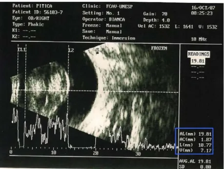 Figure 4. Ultrasonographic image (simultaneous mode A and B) of right eye of a dog with mature  cataract