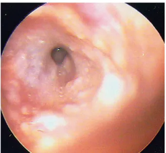 Figura  10  –  Alterações  crónicas  no  ouvido  externo  de  um  cão  atópico:  eritema,  hiperpigmentação  e  liquenificação  (Noxon,  2013)