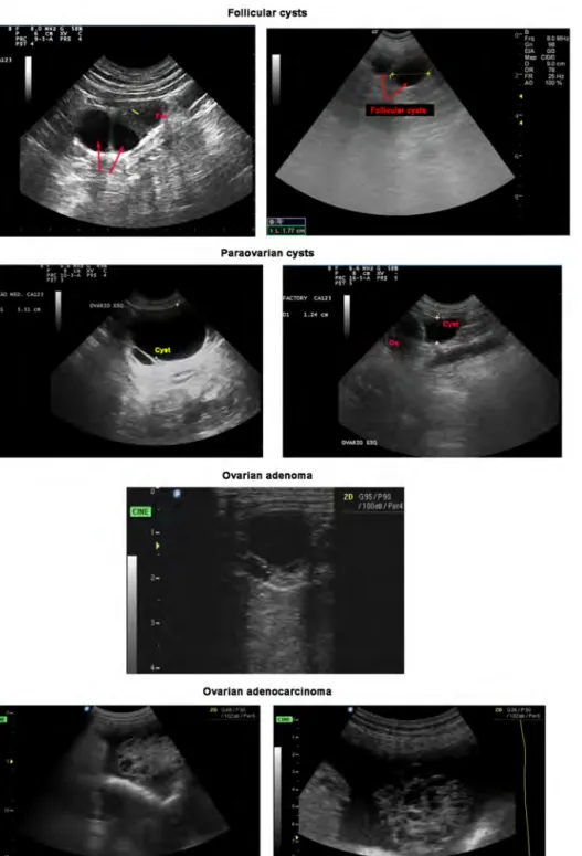 Figure 3. Ultrasonographic features of canine ovarian cysts.  Follicular cysts (arrows) appear as  anechoic structures slightly larger than co-existing follicles (Fol), and fail to evidence the regular  echoic  pattern  of  granulosa  luteinization  (yello