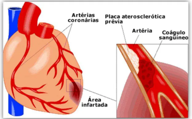 Figura 1.9:  Coração humano no evento  do  IAM. Detalhe ao lado, coágulo  sanguíneo  provocado pela obstrução da artéria coronária 53 