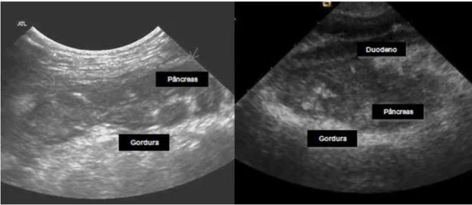 Figura  4  -  Imagens  ecográficas  típicas  de  PA:  parênquima  hipoecogénico  rodeado  de  área  hiperecogénica  de  necrose  da  gordura  peripancreática  (Adaptado  de  Mansfield,  2012  e  Watson,  2014)