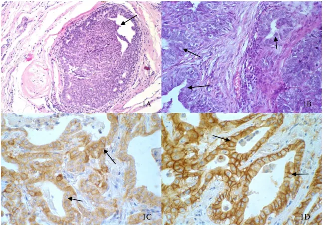 Figure  1  Canine  mammary  gland  –   (1A  -  40X)  Low  grade  carcinoma  in  situ:  intraductal  epithelial  proliferation, with monomorphic cell pattern, with no increase in nuclear size, and diffuse fine chromatin,  low nucleolar prominence, bound by 