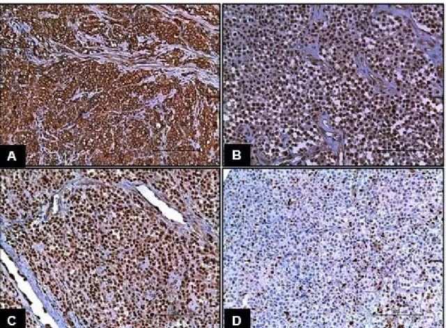 Figure 4. Photomicrographs of immunohistochemical reactions in canine TVT. (A) C-MYC. Cytoplasmic  labeling  in  I3  and  C4  scores  for  labeling  intensity  and  percentage  of  labeled  cells