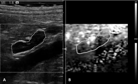 Figure 1.  Ultrasound  image  of  a  canine  adrenal during  its  qualitative  ARFI  elastography