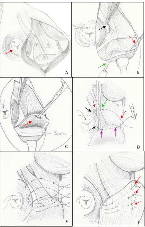 Figure 1. Schematic drawing of the anatomy of the canine right perineal region and details of the Reinforcement of  the pelvic diaphragm using a purse-string suture technique