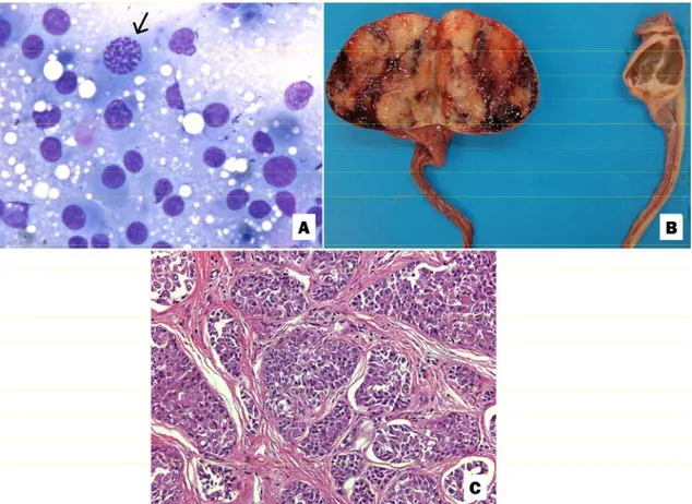 Figure 2. Testicle of a dog with a Sertoli cell tumor. A, Testicular aspirates. Intense population of round  cells  with  moderate  anisocytosis  and  anisokaryosis  as  well  as  poorly  distinguished  and  vacuolated  cytoplasm