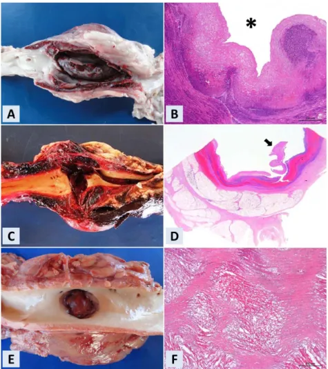 Figura  1.  Aneurismas  e  ruptura  de  aorta  em  ruminantes.  A)  Nota-se,  na  aorta  do  caprino,  dilatação  saculiforme, ruptura parcial longitudinal e sangue coagulado dissecando a parede do vaso