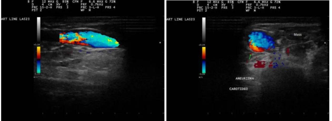 Figure 3. Dog. A) Color Doppler ultrasonography showing a sagittal plane of common carotid artery in a  dog with segmental dilation and luminal flow with aliasing artifact