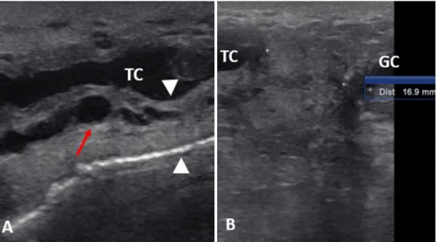 Figure 1. Ultrasonographic images of Girolando cow in the longitudinal plane showing A) the teat cistern  (TC)