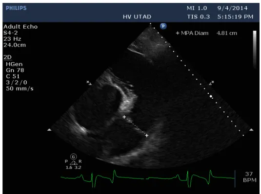 Figura 12 – Imagem obtida neste estudo a nível da artéria pulmonar, pela janela paraesternal direita  de eixo curto