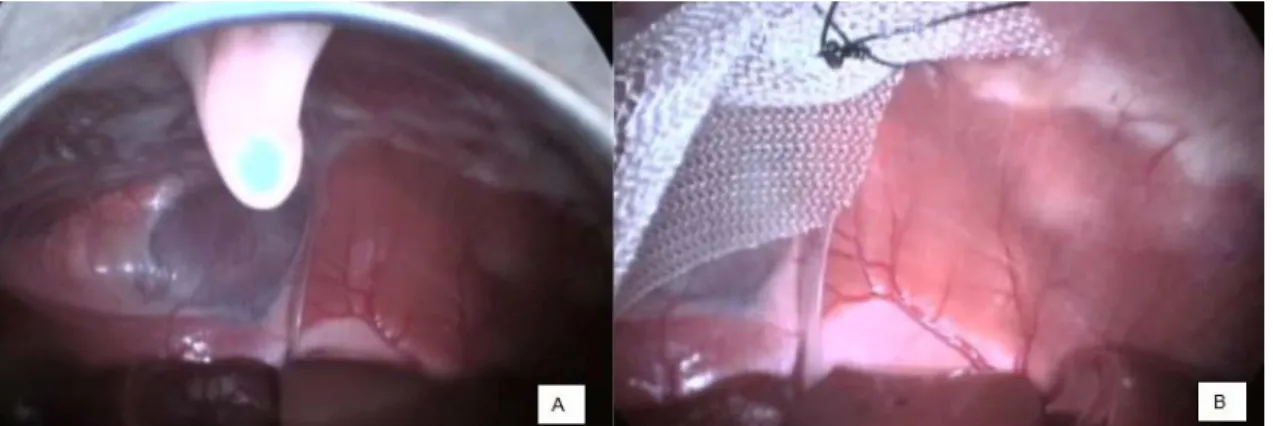 Figure  2.  Laparoscopic  view  of  a  female,  two-month-old  dog's  diaphragmatic  defect