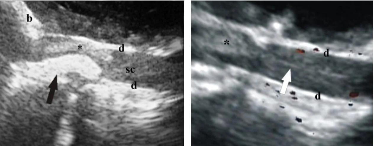 Figure  1. Sagittal  ultrasonographic  view  following  hemilaminectomy  at  L 2-3   showing  an  extruded  intervertebral  disc  (arrow)  in  dog  5