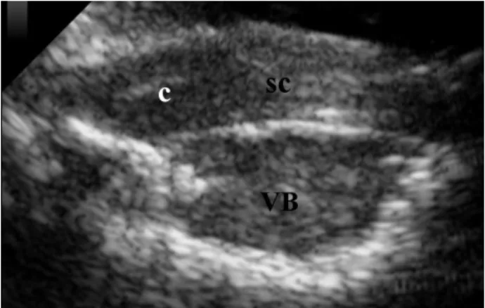 Figure 6. Sagittal ultrasonographic image of the spinal cord after laminectomy at T 12 , showing the spinal  cord (sc) as it is dislocated dorsally by an altered and hypoechoic vertebral body (VB) due to neoplasia