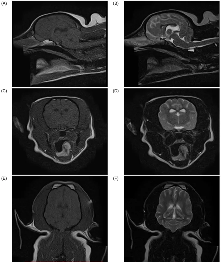 Figure 8. MRI images of different planes where no abnormalities are detected. (A) T1 sagital (B) T2  sagital (C) T1 Axial (D) T2 Axial (E) T1 Coronal (F) T2 Coronal