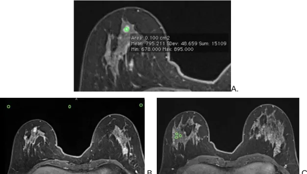 Fig.  3.5:  Exemplo  de  colocação  de  ROI  numa  lesão  benigna  em  imagem  SPAIR  última  fase  dinâmica  (A)  e  também  a  devida  colocação  dos  ROIs  no  ar  (B)  e  glândula  mamária  respectivamente  (C)
