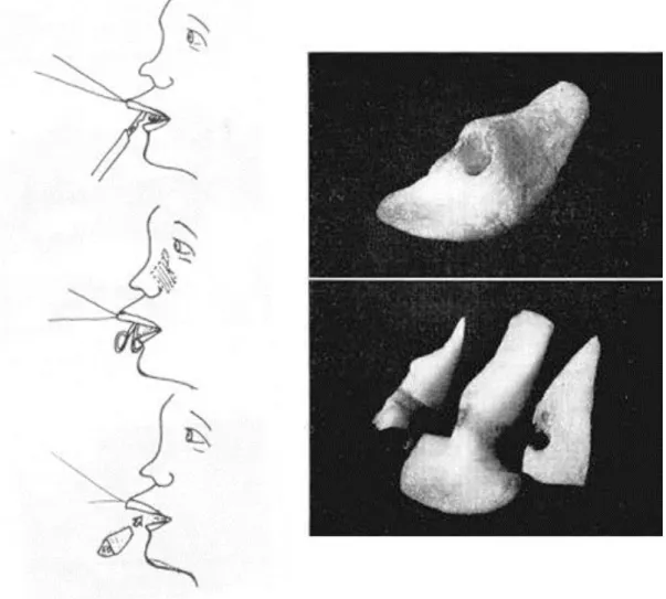 Figura 2: Representação da técnica de Gillies (post nasal inlay graft). (WINTSCH  1968)