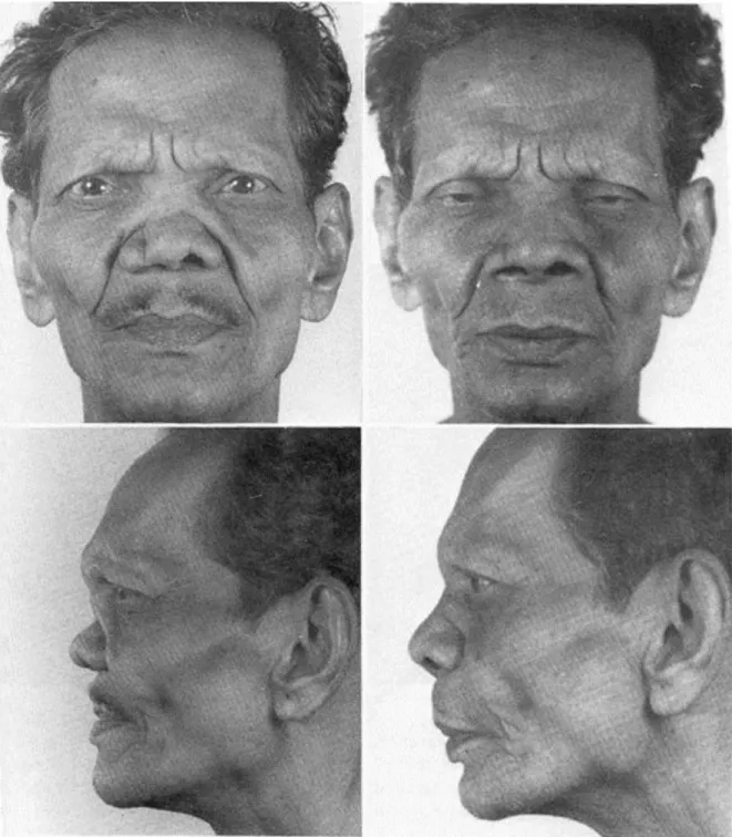 Figura  3:  Resultado  obtido  pela  técnica  de    embutimento  de  pele  pós  nasal