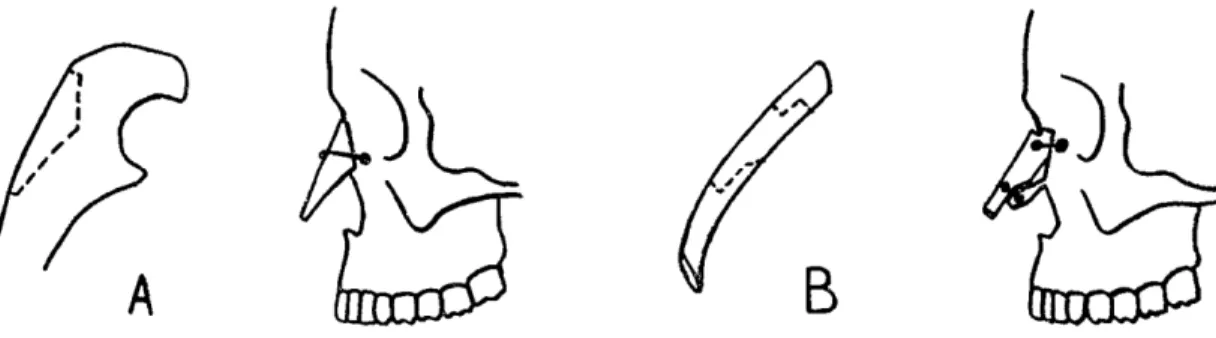 Figura 6: Desenho esquemático do enxerto de dorso nasal retirado da porção  proximal da ulna (WINTSCH 1968) 