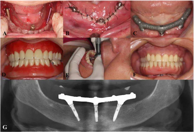 Figura 1: A  –  Posicionamento dos implantes utilizando o guia; B  –  Sutura com  os  pilares  instalados;  C  –   Prova  da  infraestrutura  metálica;  D  –   Prova  da  montagem de dentes; E – Instalação das próteses; F – Próteses instaladas; G  – Imagem