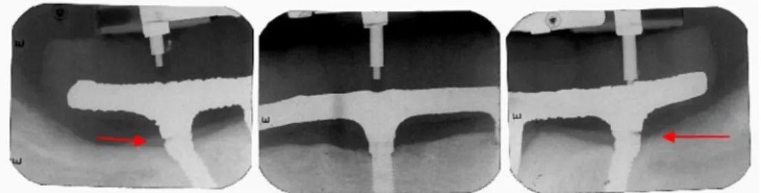 Figura 8. Imagem radiográfica da prótese insatisfatória. As setas indicam a  desadaptação