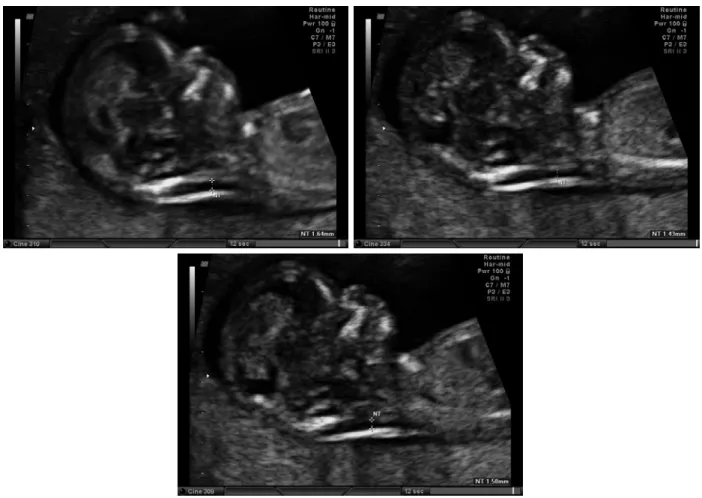 Fig. 2 - Three trials manual B-mode Ultrasound sonogram measurement results large variability,  (a) NT thickness = 1.64mm, (b) NT thickness = 1.43mm, (c) = NT thickness = 1.50mm.