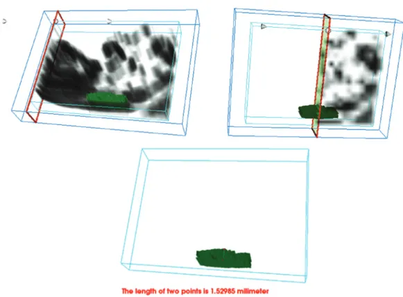 Fig. 3 - Three dimensional nuchal translucency simulation (a) 3D volumetric rendering (b) Slicing  view to show for NT segmentation (c) Thickness measurement using 3D Euclidean approach.