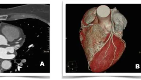 Figura  1  Imagens  ilustrativas  de  angiotomografia  coronariana  demonstrando  ausência de aterosclerose